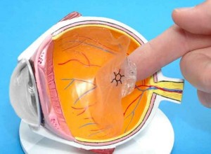 Retinal Detachment Eye Model