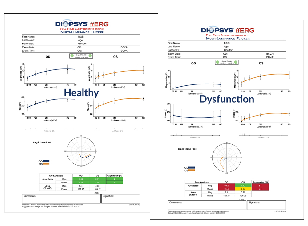 Diopsys Fferg Flicker Vision Test Results Healthy Vs Dysfunction